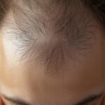 hair loss